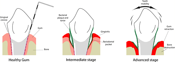 periodontal disease