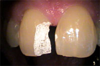 Dent cassée