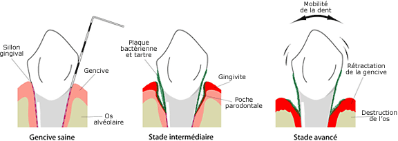 Maladie parodontale